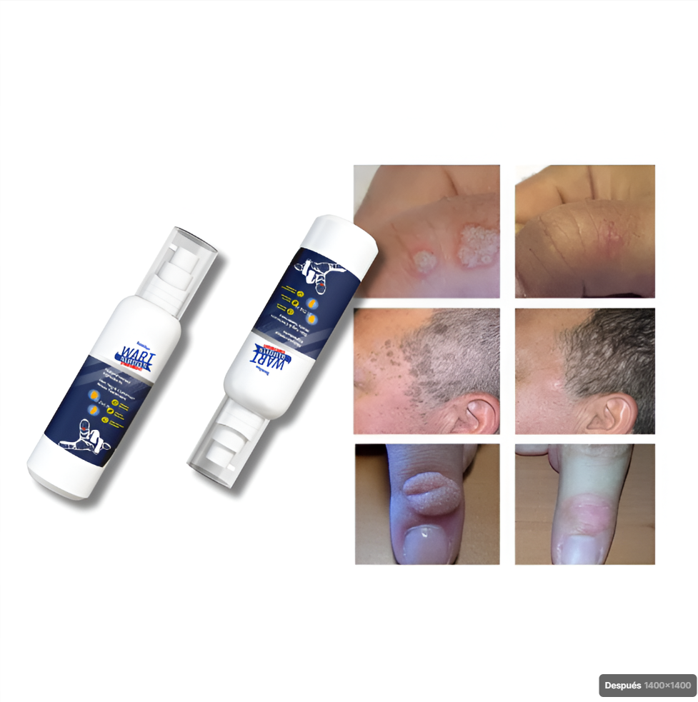WartRemover™ - Elimina verrugas sin bisturí, sin dolor y desde casa - 2 Unidades