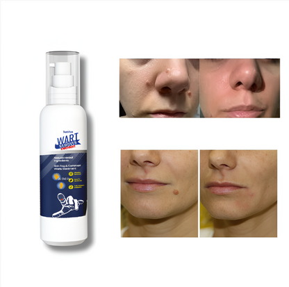 WartRemover™ - Elimina verrugas sin bisturí, sin dolor y desde casa - 2 Unidades